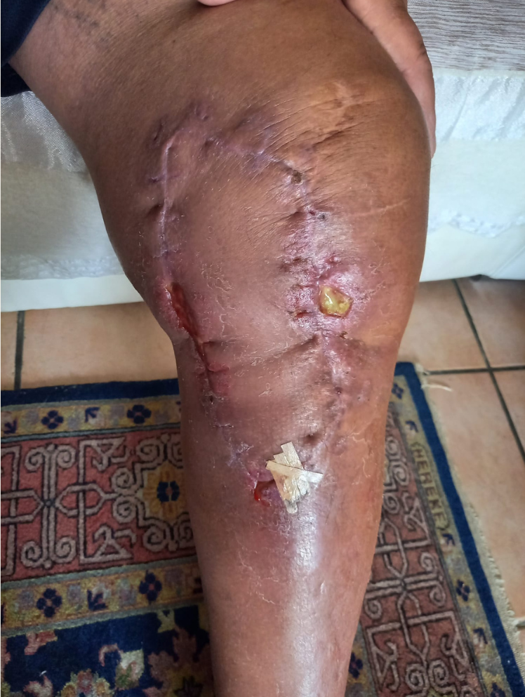 Témoignage médical Philippe F