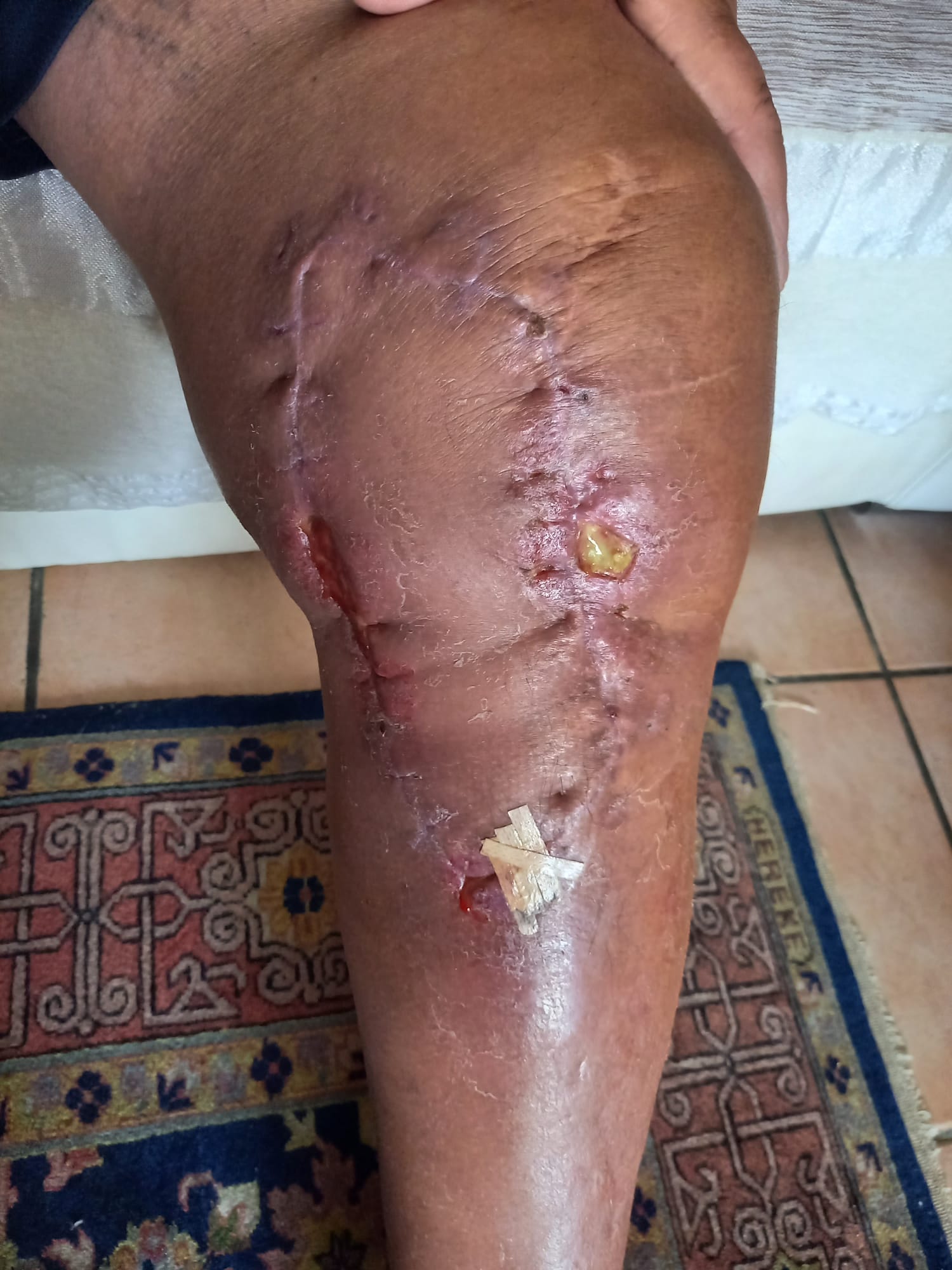 Témoignage médical Philippe F