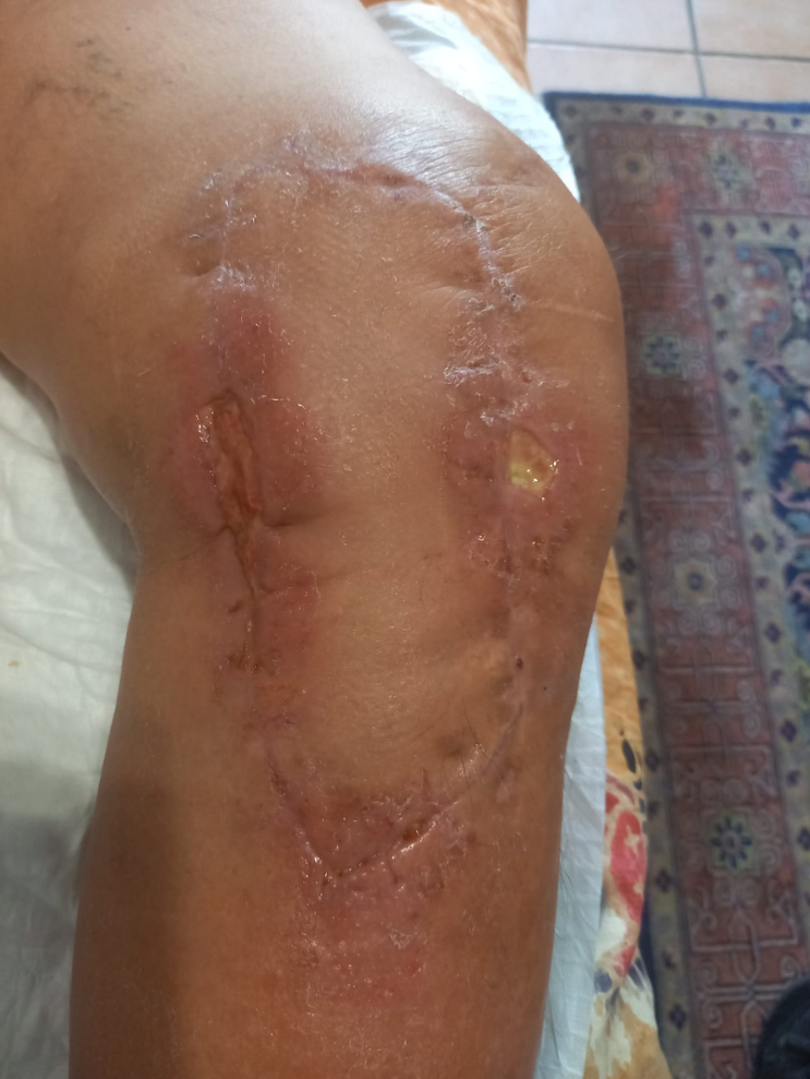 Témoignage médical Philippe F