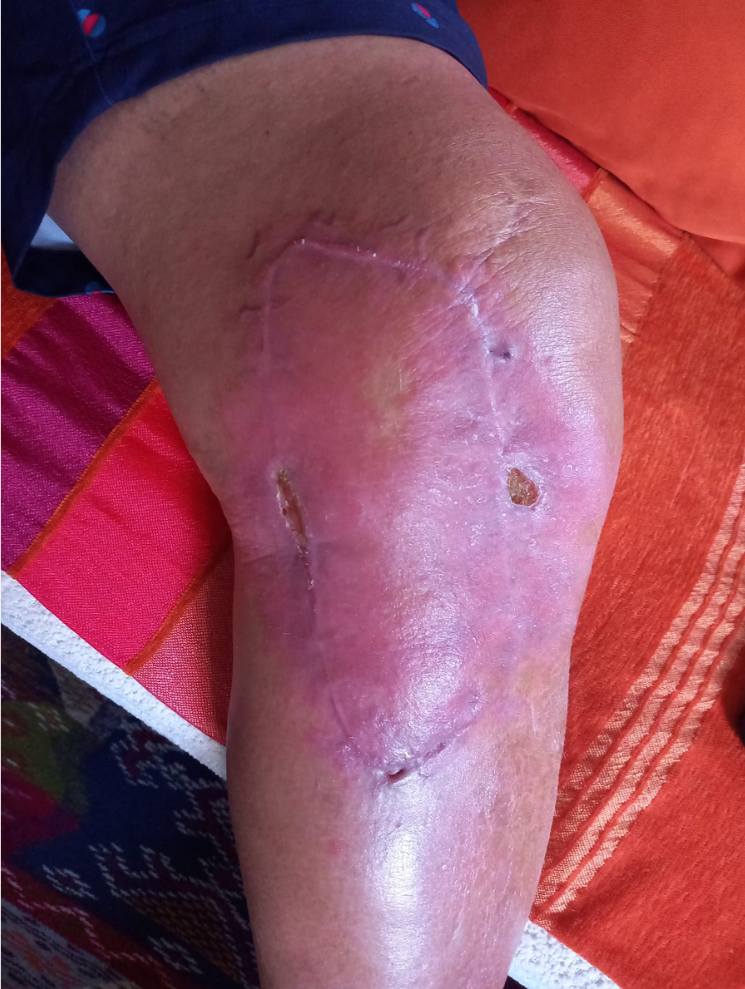 Témoignage médical Philippe F