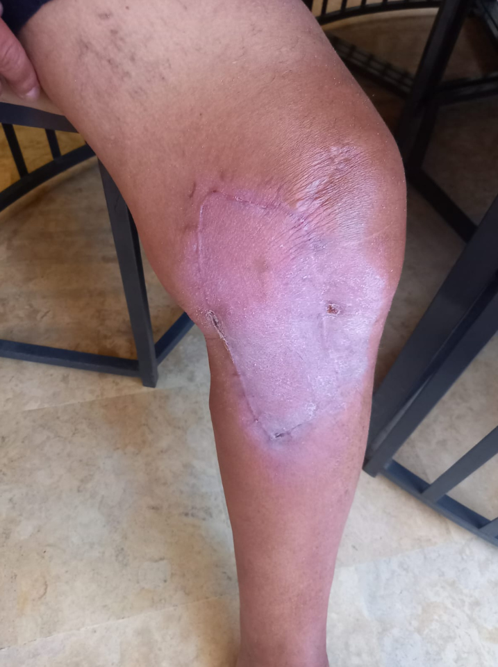 Témoignage médical Philippe F